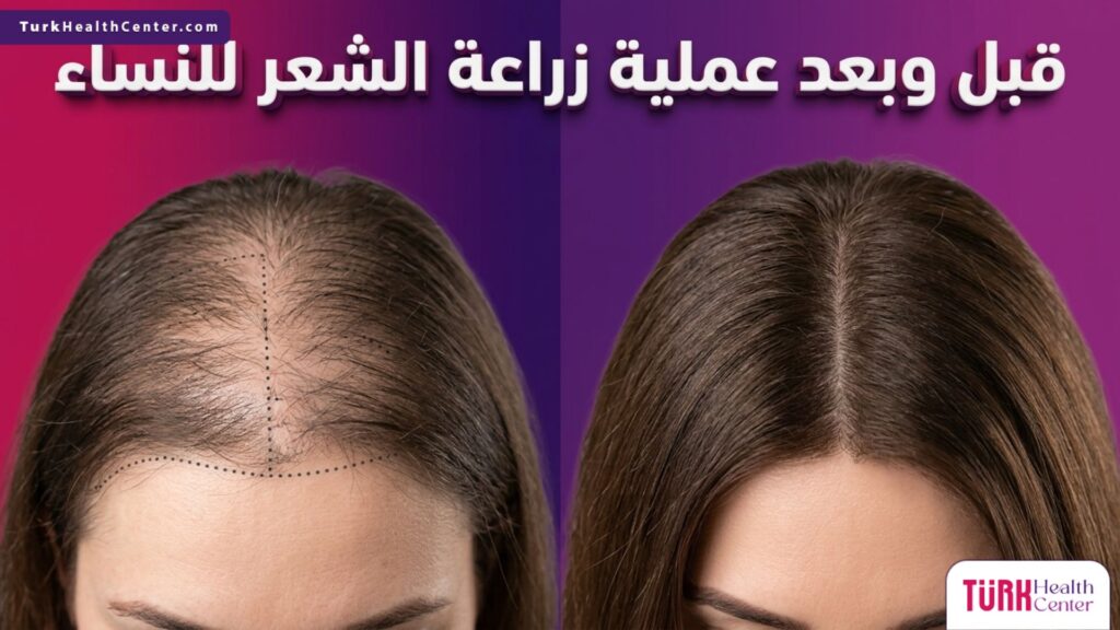 مقارنة قبل وبعد عملية زراعة الشعر للنساء تظهر تحسناً ملحوظاً في كثافة الشعر.