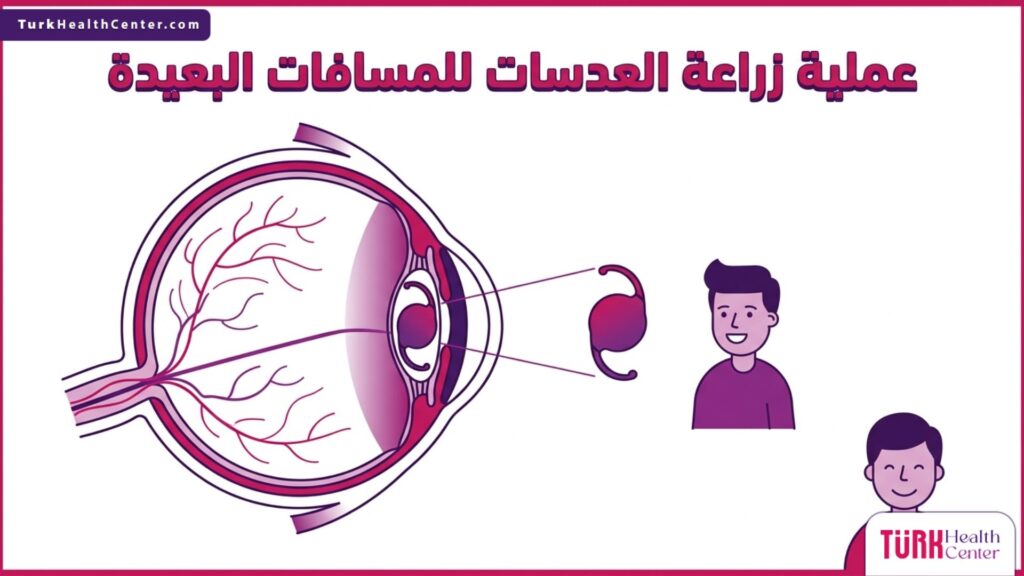 رسم تشريحي ثلاثي الأبعاد يوضح التركيب الداخلي للعين وموقع العدسة في عملية زراعة العدسات للمسافات البعيدة.
