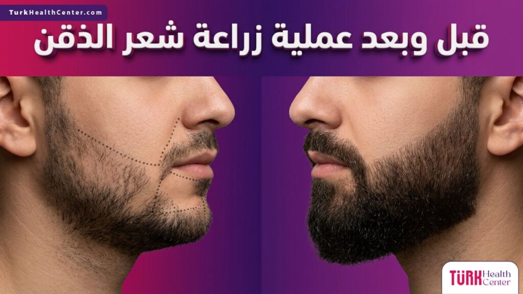 مقارنة قبل وبعد تظهر التحول المذهل والنتائج النهائية المكتملة والكثيفة بعد عملية زراعة شعر الذقن.