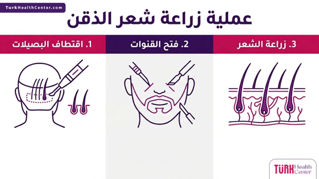 إنفوجرافيك يوضح المراحل الثلاث الأساسية والطبية المتبعة في عملية زراعة شعر الذقن بنجاح.