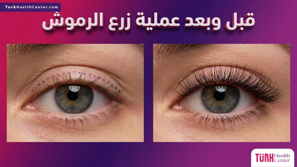 مقارنة قبل وبعد عملية زرع الرموش تظهر كثافة الرموش الطبيعية والجذابة بعد الإجراء الطبي.