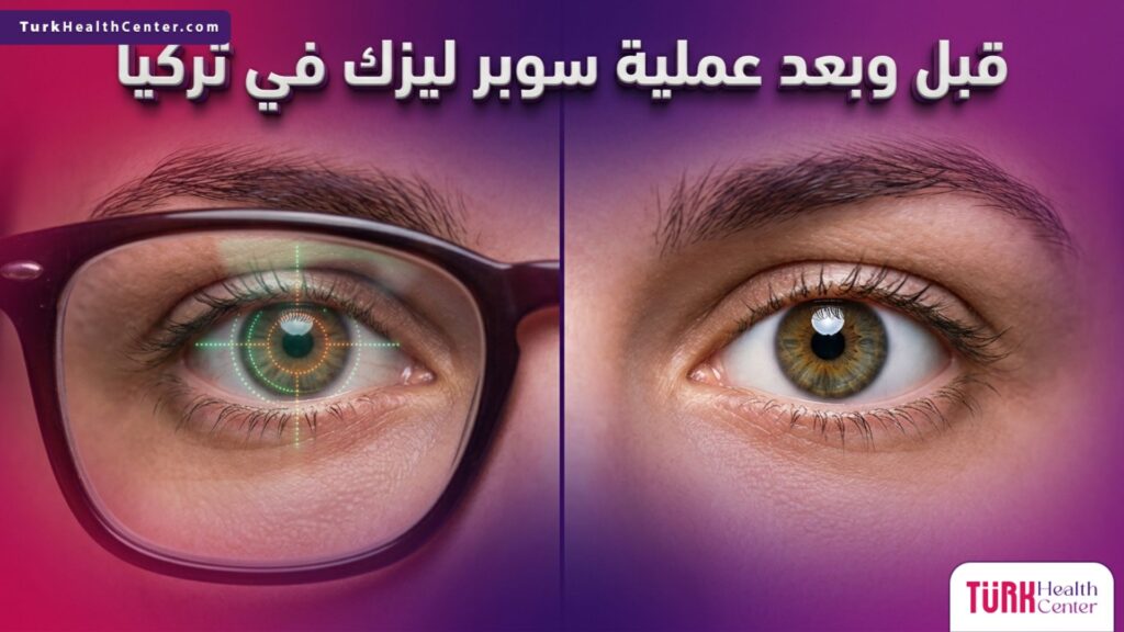 صورة مقسمة توضح الفرق في الرؤية وصحة العين قبل وبعد عملية سوبر ليزك في تركيا مع إرشادات طبية دقيقة