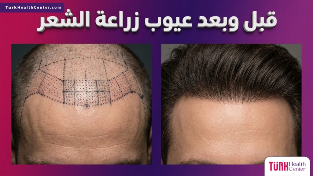 صورة مقسمة توضح حالة فروة الرأس قبل وبعد التعامل الاحترافي مع عيوب زراعة الشعر لتجنب المضاعفات.