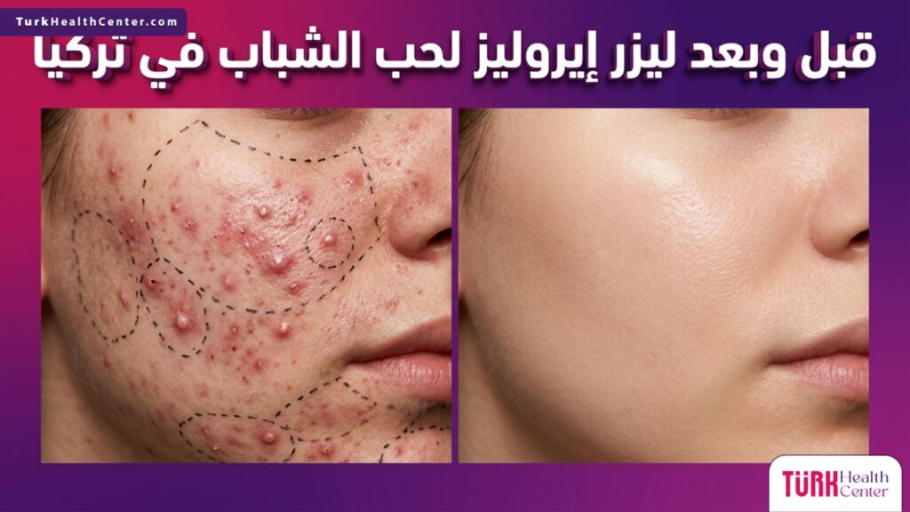 مقارنة قبل وبعد توضح نتائج علاج ليزر إيروليز لحب الشباب في تركيا على البشرة.