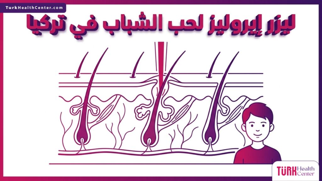 مخطط طبي يوضح آلية عمل ليزر إيروليز لحب الشباب في تركيا داخل طبقات الجلد.