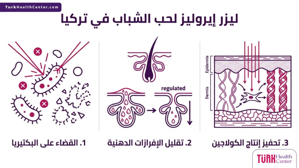 إنفوجرافيك يشرح الفوائد الثلاثية لتقنية ليزر إيروليز لحب الشباب في تركيا.