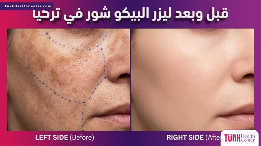 صورة مقسومة واقعية تظهر نتائج التجميل قبل وبعد ليزر البيكو شور في تركيا، توضح التخلص من التصبغات والحصول على بشرة نقية وصافية.