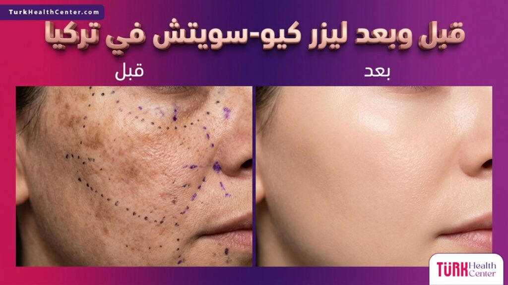 صورة مقسمة تظهر حالة البشرة قبل وبعد إجراء ليزر كيو-سويتش في تركيا لإزالة التصبغات وتوحيد لون الجلد.