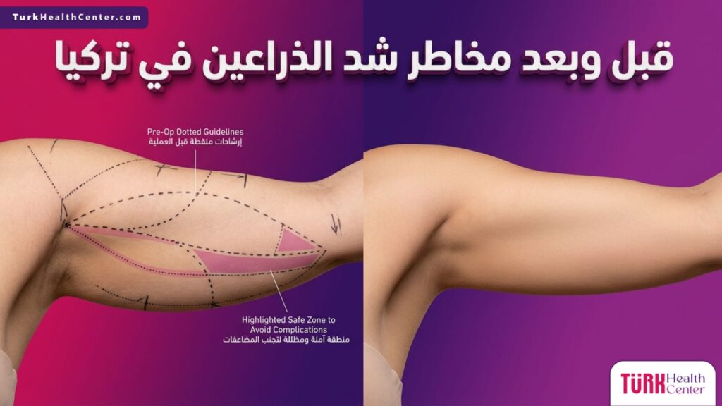 مقارنة قبل وبعد لتوضيح أهمية التخطيط الجراحي السليم لتجنب مخاطر شد الذراعين في تركيا.