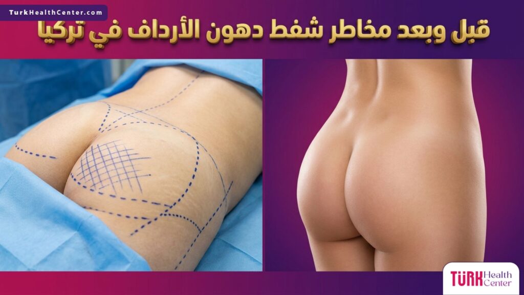 صورة مقسمة تظهر التخطيط الجراحي الدقيق لتجنب مخاطر شفط دهون الأرداف في تركيا قبل وبعد العملية.