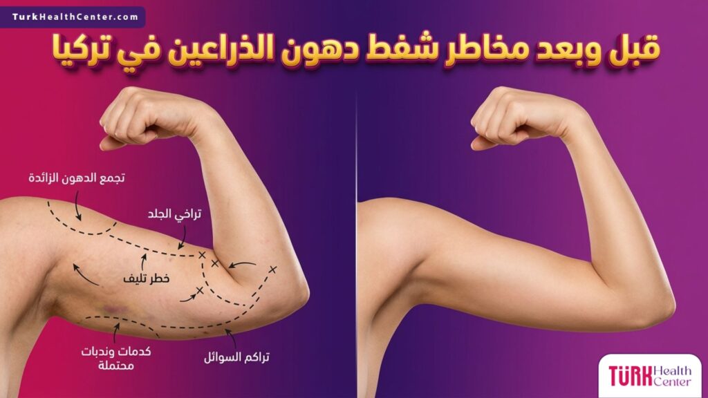 مقارنة قبل وبعد تظهر تفادي مخاطر شفط دهون الذراعين في تركيا للحصول على ذراع مشدودة