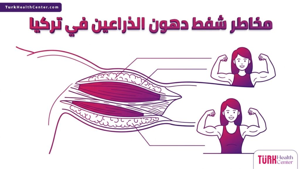 مخطط تشريحي طبي يشرح طبقات الجلد ويوضح كيفية تجنب مخاطر شفط دهون الذراعين في تركيا