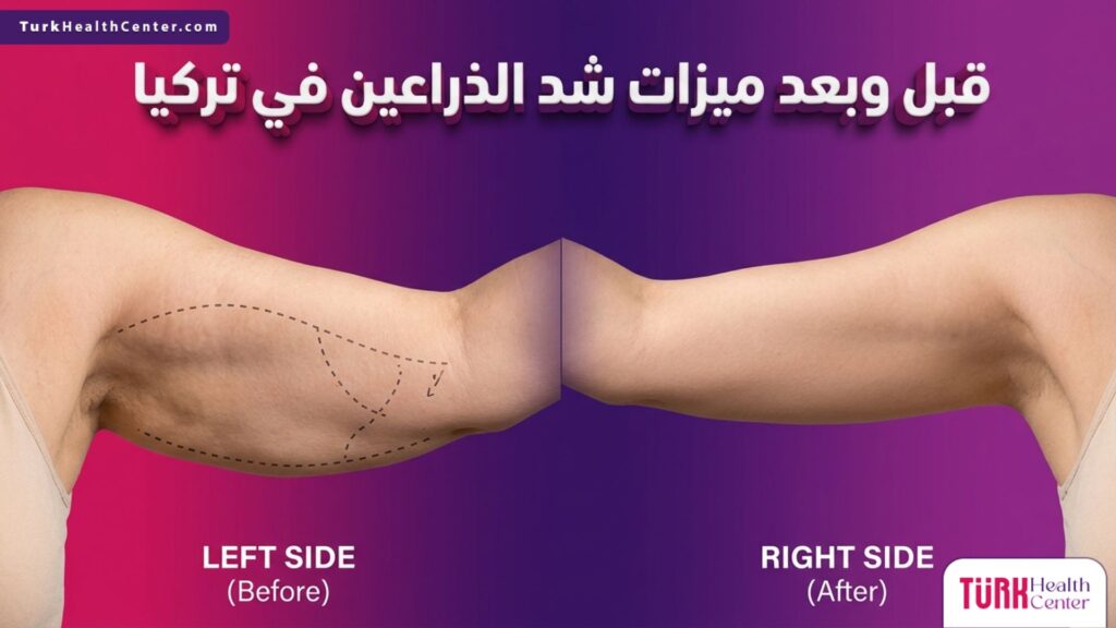 مقارنة واقعية قبل وبعد توضح ميزات شد الذراعين في تركيا مع خطوط الجراحة التجميلية للذراع المترهلة والنتيجة المشدودة.