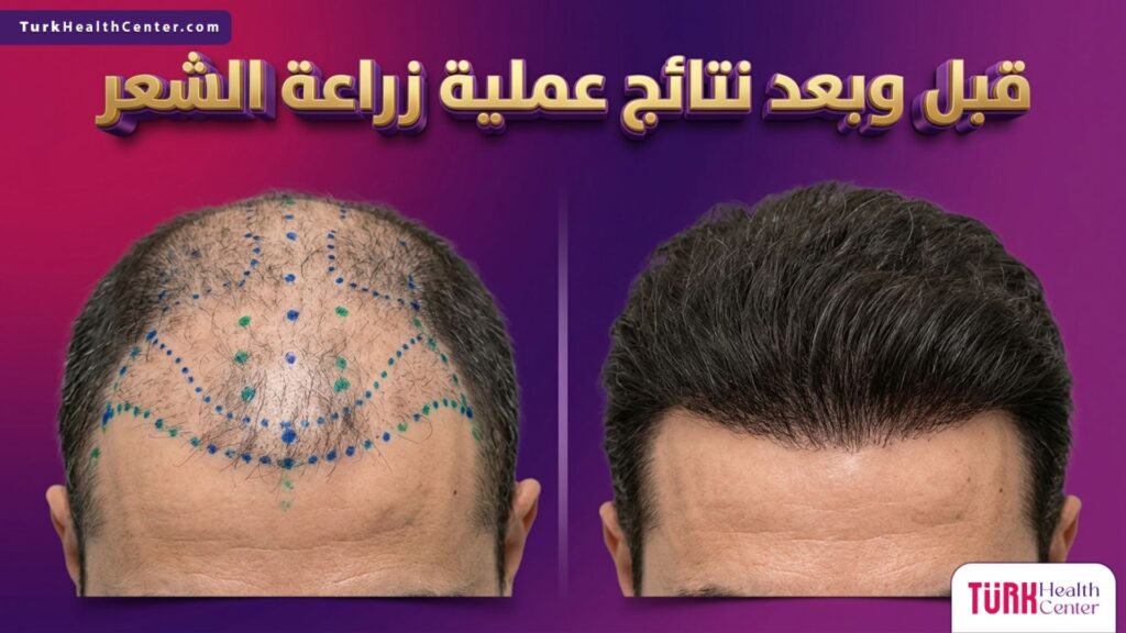 مقارنة دقيقة تظهر قبل وبعد نتائج عملية زراعة الشعر توضح كثافة الشعر ونموه.