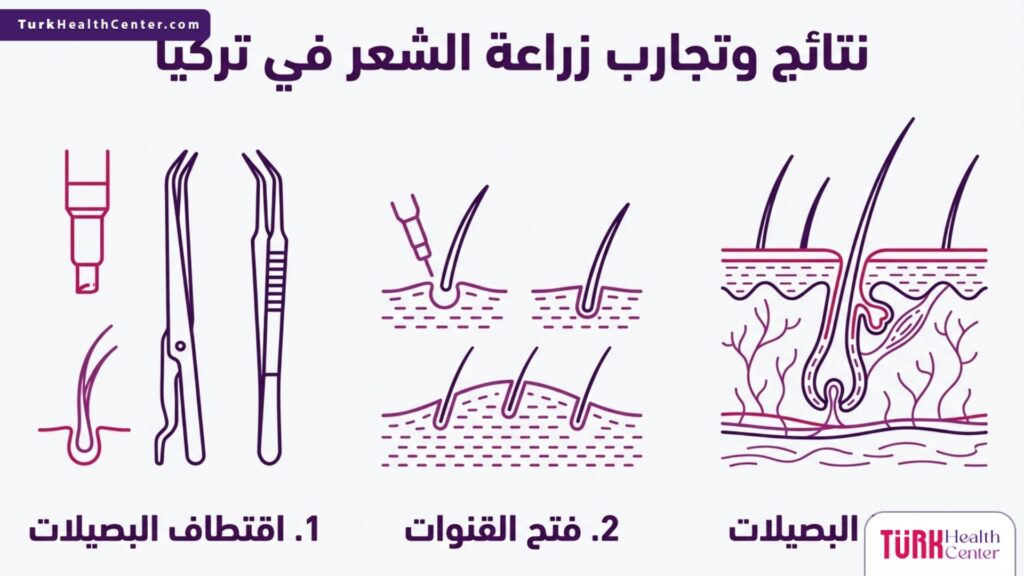 تصميم إنفوجرافيك لثلاث مراحل أساسية توضح نتائج وتجارب زراعة الشعر في تركيا.