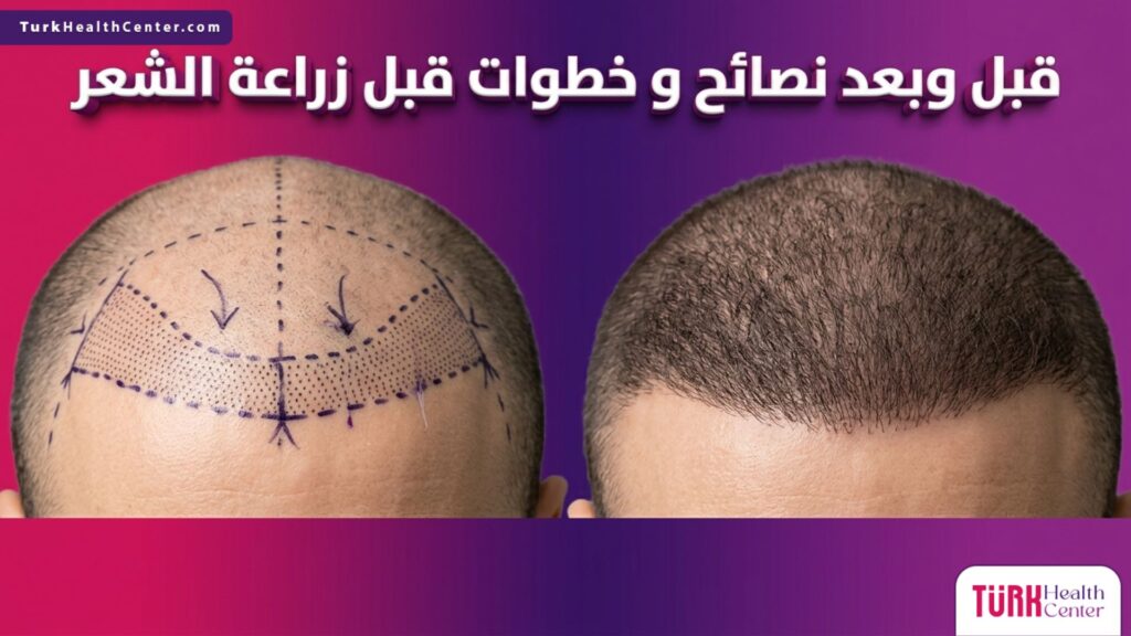 مقارنة قبل وبعد تبرز تأثير الالتزام بتطبيق نصائح و خطوات قبل زراعة الشعر على كثافة وصحة البصيلات المزروعة.