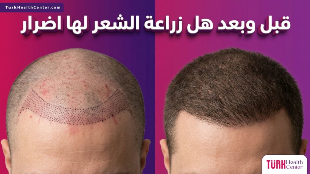 مقارنة قبل وبعد توضح مراحل التعافي وتجيب على سؤال هل زراعة الشعر لها اضرار بمرور الوقت حتى الحصول على النتيجة النهائية.