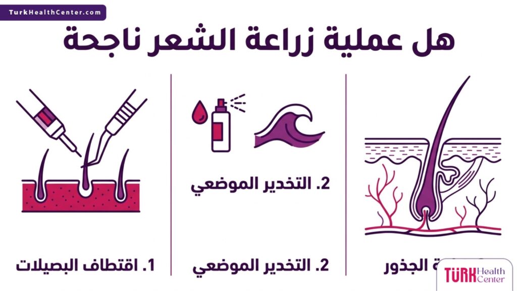 مخطط طبي بخطوات علمية يشرح الإجراءات الجراحية ويجيب على تساؤل هل عملية زراعة الشعر ناجحة