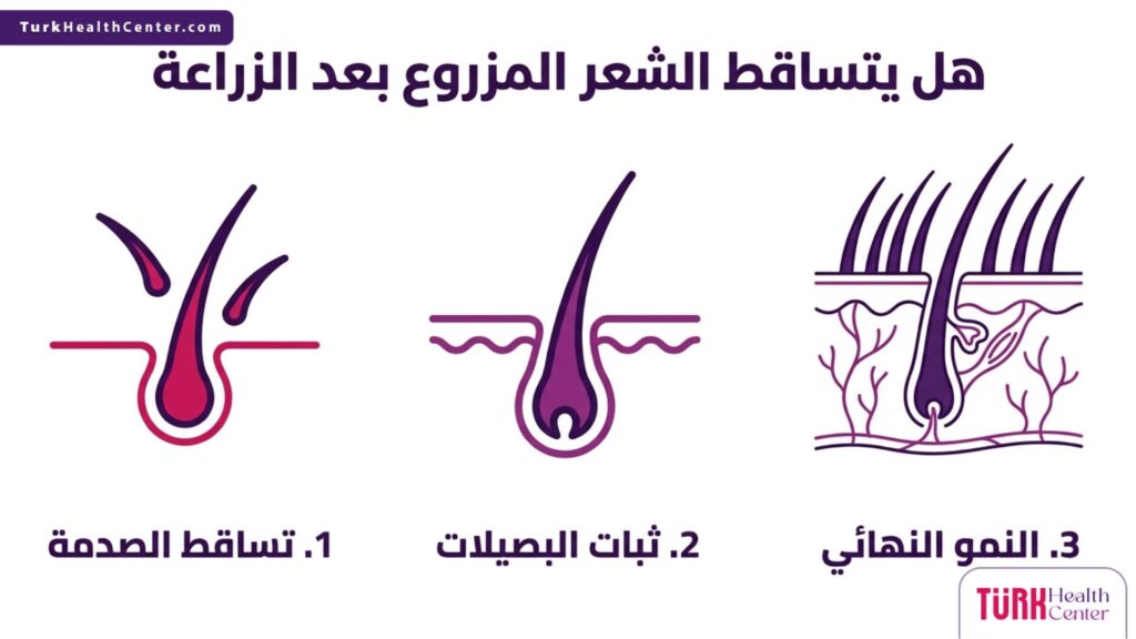 إنفوجرافيك طبي يشرح مراحل ما بعد العملية والإجابة على هل يتساقط الشعر المزروع بعد الزراعة في ثلاث خطوات.