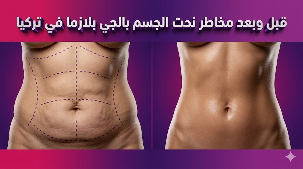 صورة قبل وبعد تظهر علامات جراحية ونتائج شد الجلد المتعلقة بموضوع مخاطر نحت الجسم بالجي بلازما في تركيا.