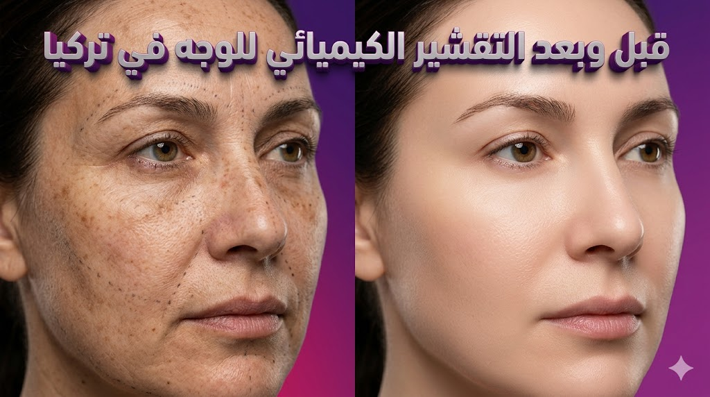 صورة قبل وبعد توضح نتائج التقشير الكيميائي للوجه في تركيا على نضارة وتوحيد لون البشرة.