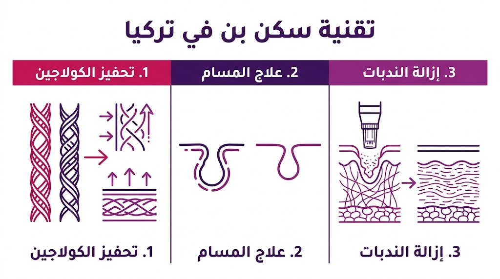 إنفوجرافيك تعليمي يشرح الفوائد الثلاث الرئيسية لاستخدام تقنية سكن بن في تركيا لتحسين جودة الجلد.