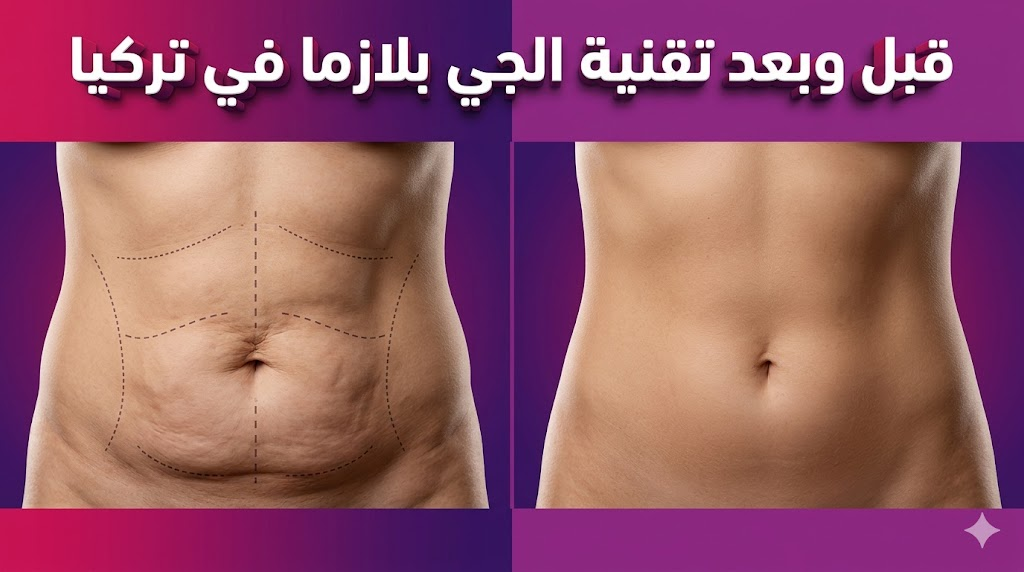 مقارنة قبل وبعد لنتائج شد الجلد المذهلة باستخدام تقنية الجي بلازما في تركيا لمنطقة البطن.