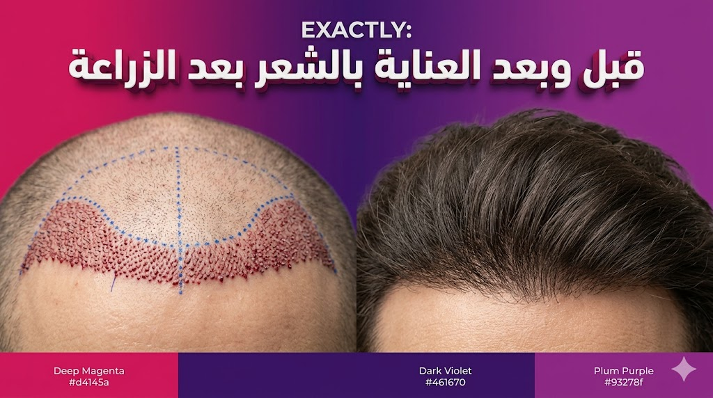 مقارنة قبل وبعد تظهر نتائج الالتزام بجدول العناية بالشعر بعد الزراعة مع فروة رأس صحية وشعر كثيف.