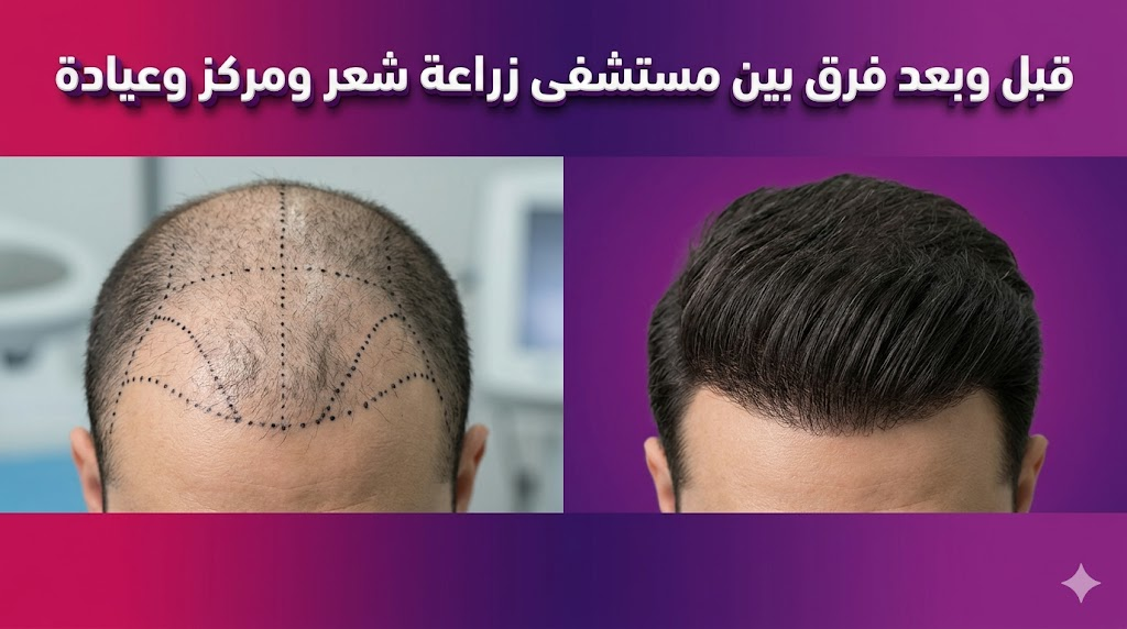 مقارنة قبل وبعد توضح نتائج زراعة الشعر والفرق في الجودة عند اختيار فرق بين مستشفى زراعة شعر ومركز وعيادة.