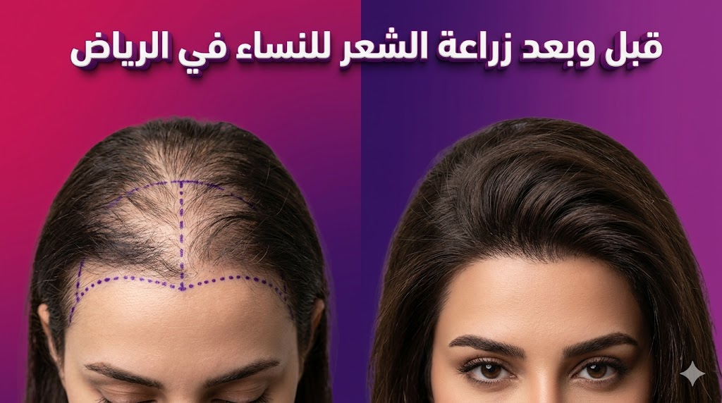 صورة "قبل وبعد" توضح نتائج زراعة الشعر للنساء في الرياض مع إظهار كثافة الشعر الطبيعية بعد العملية.