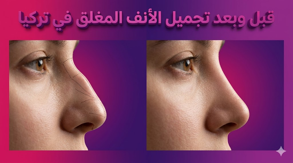  صورة قبل وبعد تجميل الأنف المغلق في تركيا تظهر دقة النتائج واختفاء الندبات تماماً مع خلفية احترافية.