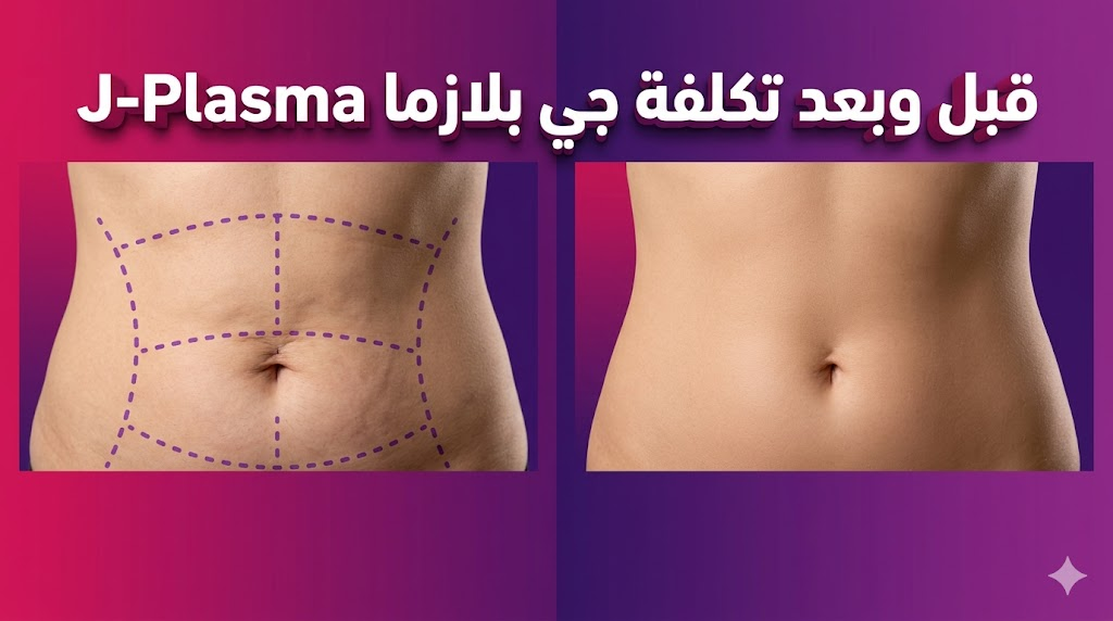  مقارنة واقعية قبل وبعد توضح فعالية تكلفة جي بلازما J-Plasma في شد ترهلات الجلد.