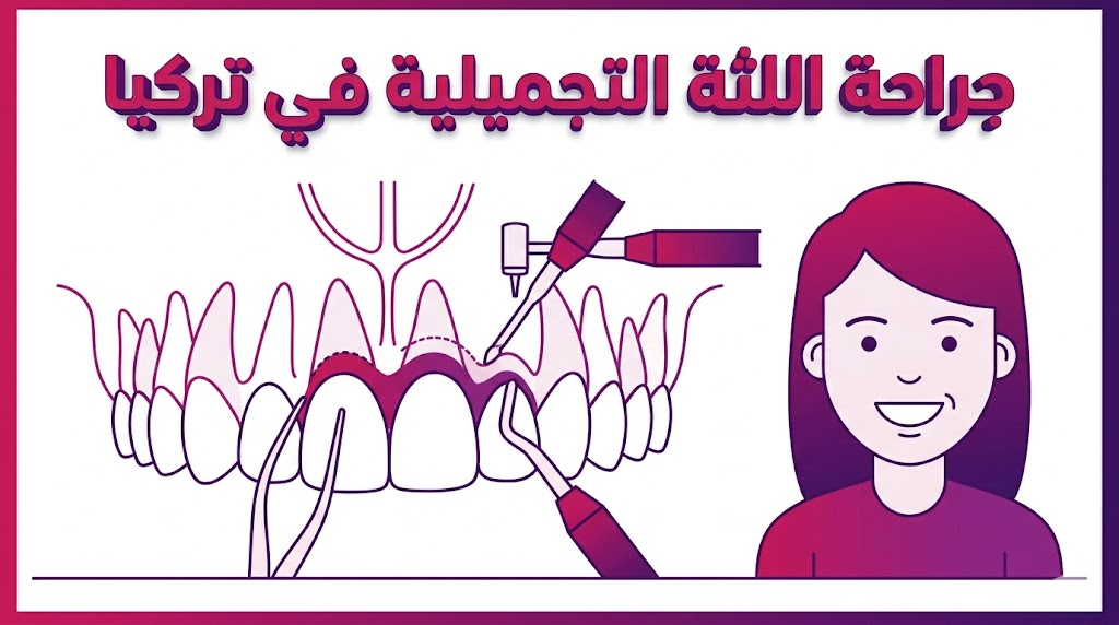 إنفوجرافيك طبي يوضح التشريح الدقيق والأسلوب العلمي المتبع في جراحة اللثة التجميلية في تركيا.