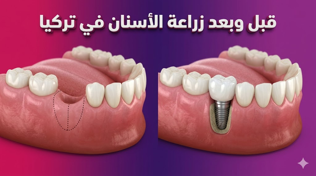 صورة واقعية تظهر مقارنة قبل وبعد عملية زراعة الأسنان في تركيا مع توضيح جودة الغرسة السنية والتاج.