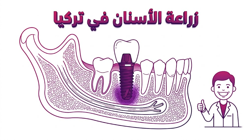 مخطط إنفوجرافيك طبي يوضح الجانب التشريحي لعملية زراعة الأسنان في تركيا وكيفية تثبيت الغرسة في العظم.
