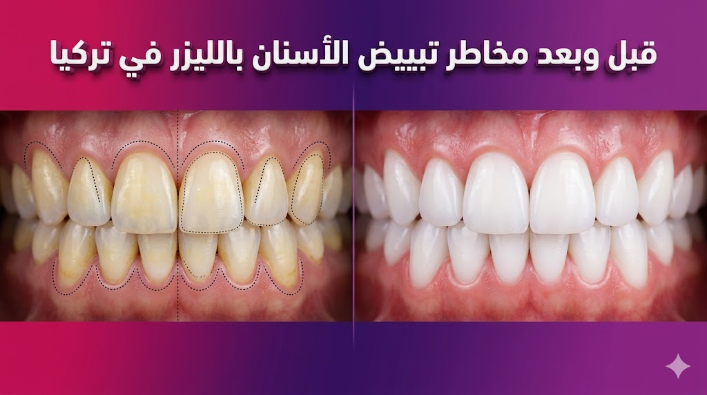 مقارنة قبل وبعد توضح نتائج تبييض الأسنان مع إشارات طبية حول مخاطر تبييض الأسنان بالليزر في تركيا وكيفية تجنبها.