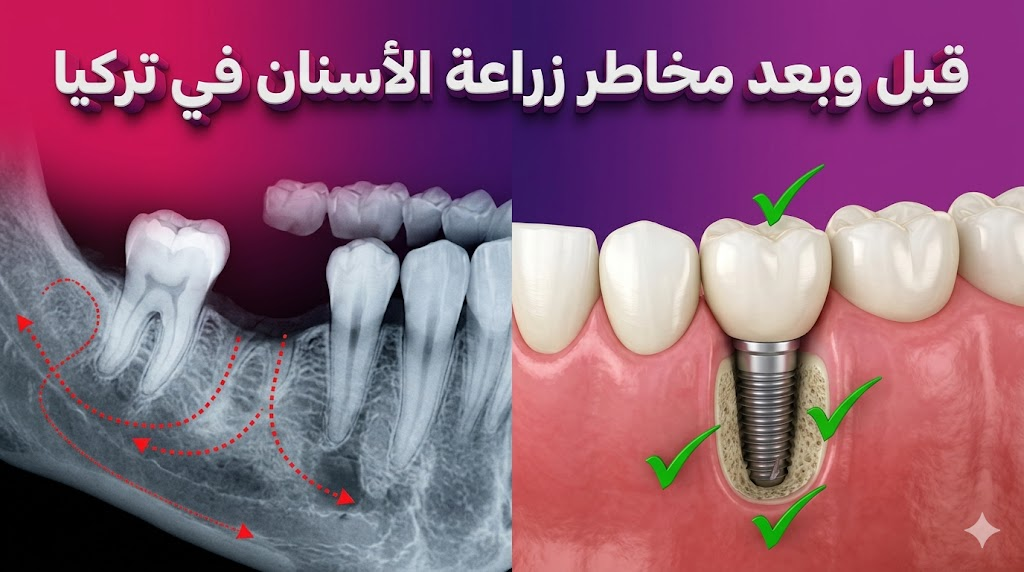 مقارنة قبل وبعد تظهر معالجة فجوات الأسنان وتجنب مخاطر زراعة الأسنان في تركيا عبر تقنيات دقيقة.