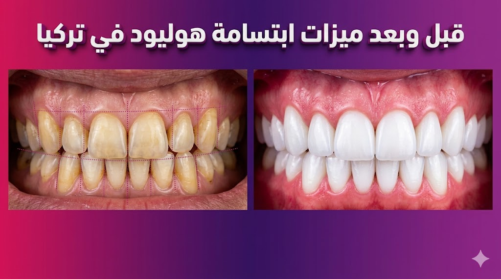 صورة قبل وبعد توضح ميزات ابتسامة هوليود في تركيا من خلال مقارنة بين أسنان غير متناسقة وأسنان مثالية ناصعة البياض.