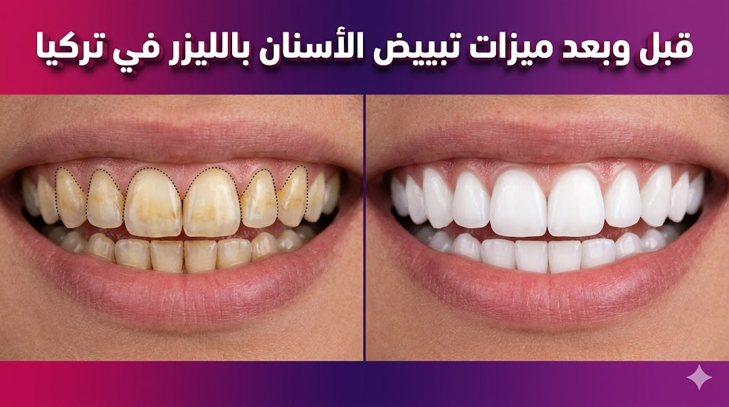 صورة قبل وبعد توضح نتائج ميزات تبييض الأسنان بالليزر في تركيا وتأثيرها على بياض الابتسامة.