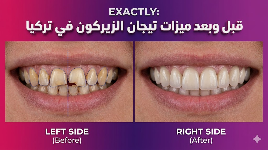 مقارنة واقعية قبل وبعد تظهر تحولاً جذرياً لابتسامة مريض باستخدام تيجان الزيركون في تركيا، توضح المظهر الطبيعي والجميل.
