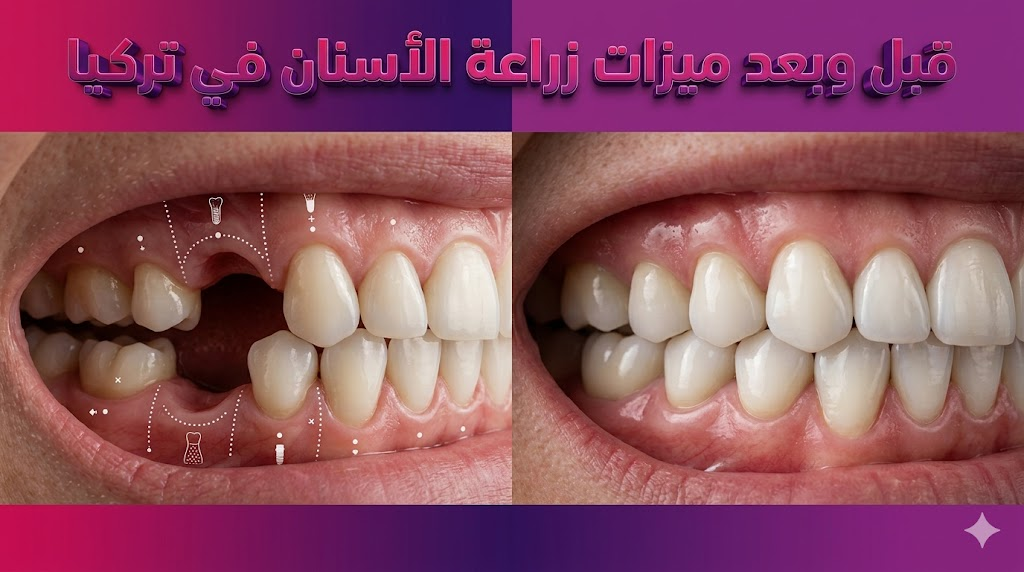مقارنة قبل وبعد تظهر ميزات زراعة الأسنان في تركيا من خلال استبدال الأسنان المفقودة بغرسات دقيقة.