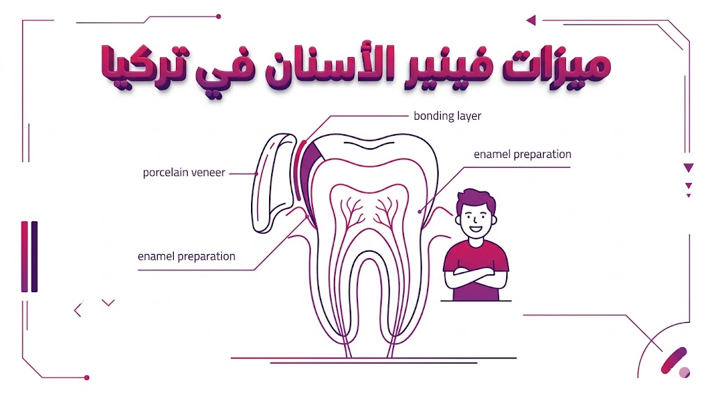 مخطط تشريحي يوضح ميزات فينير الأسنان في تركيا وطريقة تركيب العدسات اللاصقة للأسنان.