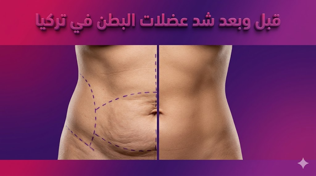 مقارنة قبل وبعد شد عضلات البطن في تركيا توضح التخلص من الترهلات والحصول على عضلات مشدودة ونتائج مثالية.