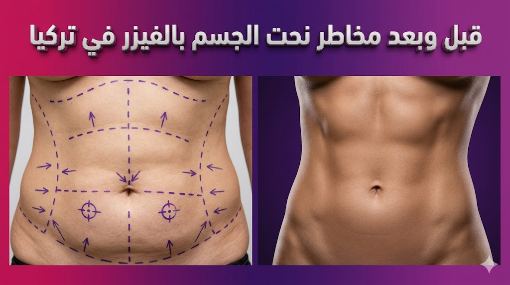 مقارنة قبل وبعد توضح نتائج وعملية مخاطر نحت الجسم بالفيزر في تركيا مع علامات جراحية.