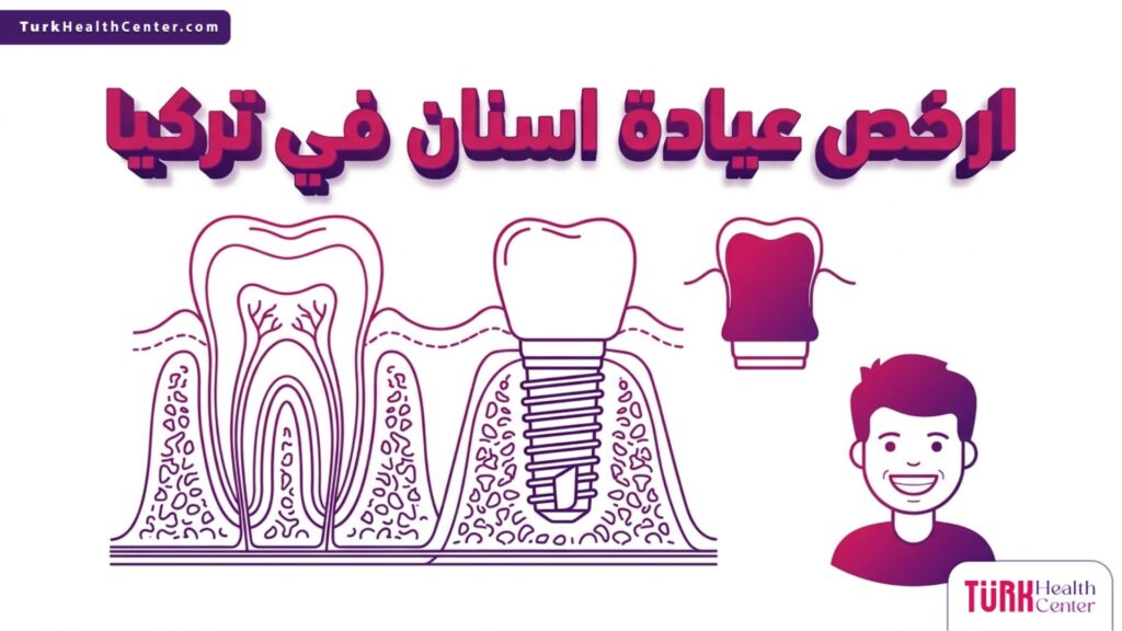 إنفوجرافيك طبي تشريحي يوضح هيكل السن وعملية الزراعة الدقيقة في ارخص عيادة اسنان في تركيا.