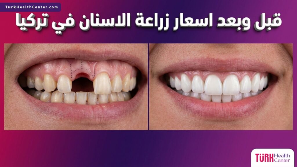مقارنة قبل وبعد توضح نتائج الإجراء الطبي وتفاصيل اسعار زراعة الاسنان في تركيا بابتسامة مثالية.