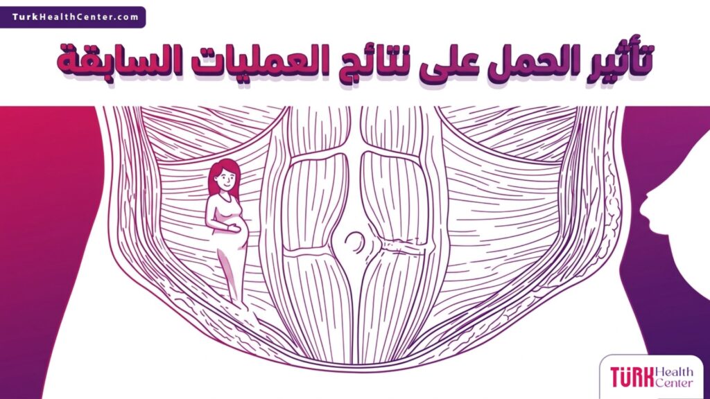 رسم تشريحي دقيق يوضح تأثير الحمل على نتائج العمليات السابقة من حيث مرونة الجلد وعضلات البطن.