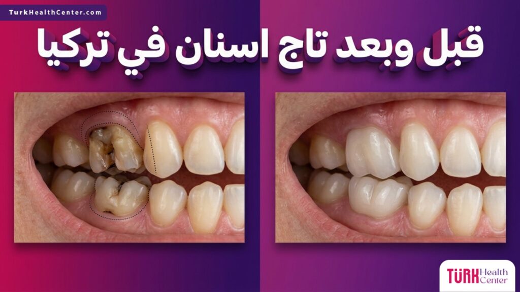 مقارنة قبل وبعد توضح نتائج تركيب تاج اسنان في تركيا لاستعادة شكل السن الطبيعي.