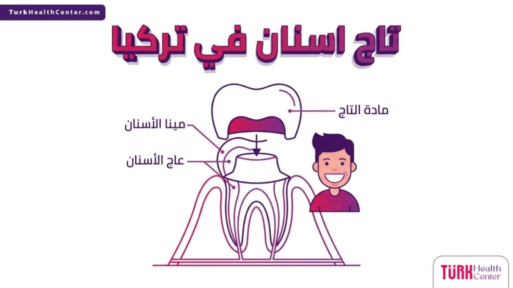 مخطط تشريحي يوضح كيفية تثبيت تاج اسنان في تركيا فوق السن الطبيعي بشكل علمي دقيق.