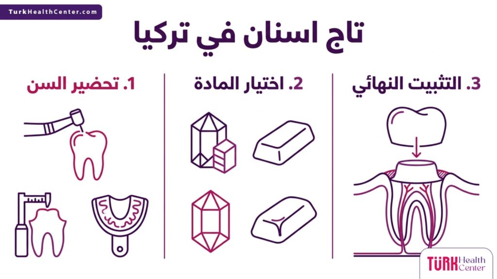 إنفوجرافيك تعليمي يشرح خطوات تركيب تاج اسنان في تركيا من التحضير حتى التثبيت.